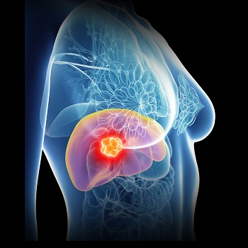 Métastases hépatiques du cancer du sein | Institut Jules Bordet