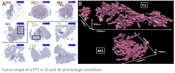 tumor shape of a PTC in 2D and 3D at histologic resolution
