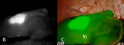 chirurgie laparoscopique