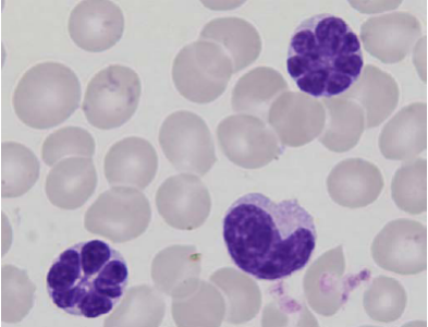 Globules blancs en forme de fleur caractéristiques de la leucémie virale