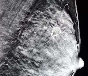 breast radiology