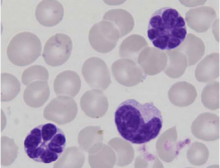 leukemie